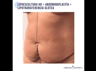 Lipoescultura HD + abdominoplastia + lipotransferencia glútea