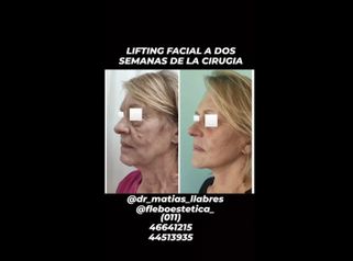 Lifting - Dr. Matías Llabres