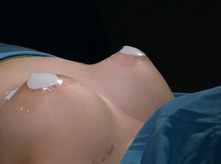 Aumento Mamario - Dr. Fernando Glaria