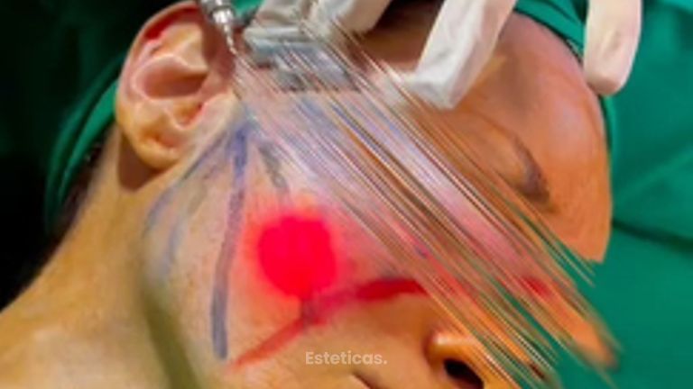 Endoláser - Dr. Rodolfo Villavicencio