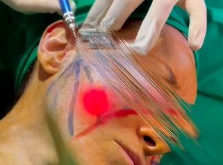 Endoláser - Dr. Rodolfo Villavicencio
