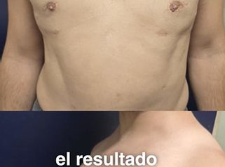 Ginecomastia. Pacientes que ya fueron operados - Dra. Natalia Solimano