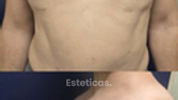 Ginecomastia. Pacientes que ya fueron operados - Dra. Natalia Solimano