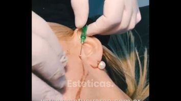 Hilos tensores faciales - Dr. Víctor Armesto