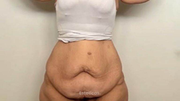 Lipo brazos - muslos - caderas - Dr. Emmanuel Manavela Chiapero