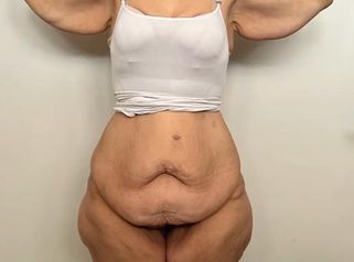 Lipo brazos - muslos - caderas - Dr. Emmanuel Manavela Chiapero