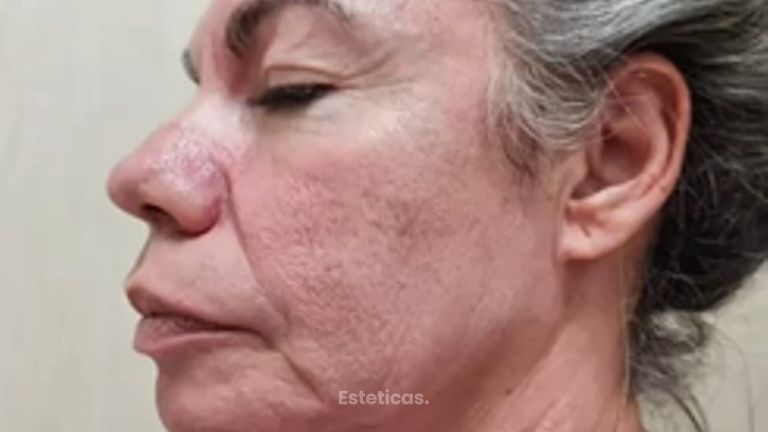 Blefaroplastia - Dr. Matías Llabres