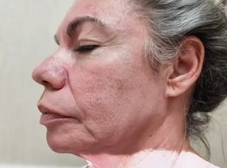 Blefaroplastia - Dr. Matías Llabres