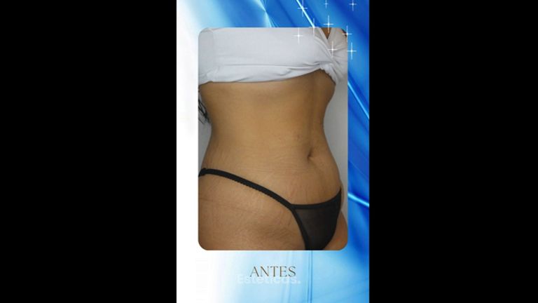 Abdominoplastia - Dr. Rodolfo Villavicencio
