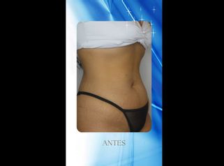Abdominoplastia - Dr. Rodolfo Villavicencio