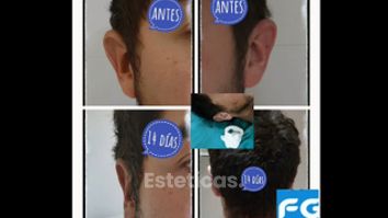 Otoplastia - Dr. Gastón Eduardo Ferreira