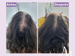 Plasma capilar - Dra. Haylen Solarte