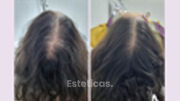 Plasma capilar - Dra. Haylen Solarte