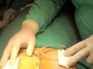 Aumento mamas - Dr. Walter Gabriel Huck - Centro Médico Alvear