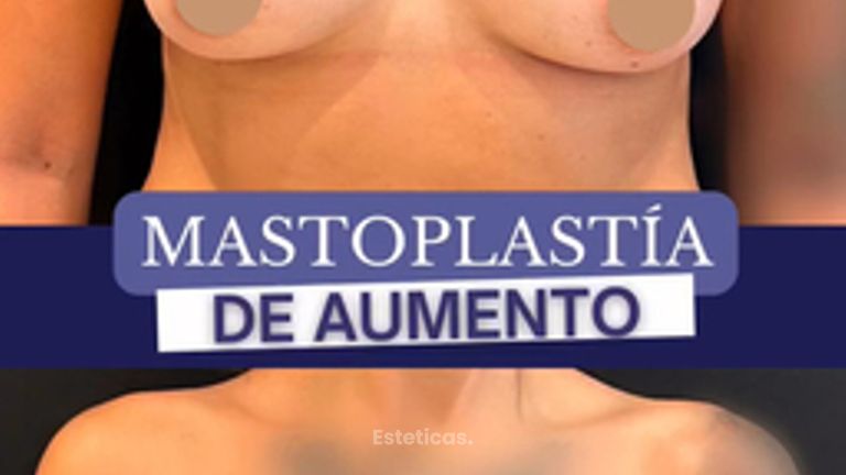Aumento mamas - Dr. Agustín Matia