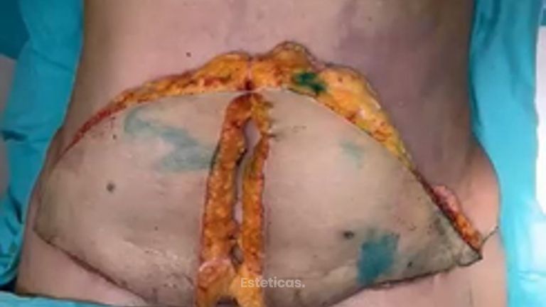 Abdominoplastia - Dra. Maria Victoria Rodriguez