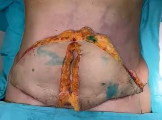 Abdominoplastia - Dra. Maria Victoria Rodriguez