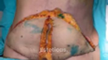 Abdominoplastia - Dra. Maria Victoria Rodriguez