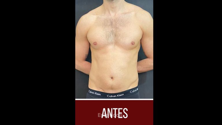 Liposucción - Dr. Emmanuel Manavela Chiapero