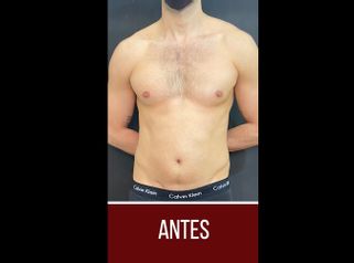 Liposucción - Dr. Emmanuel Manavela Chiapero