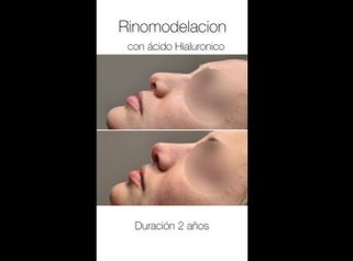 Rinomodelación - Dr Luis Corrales