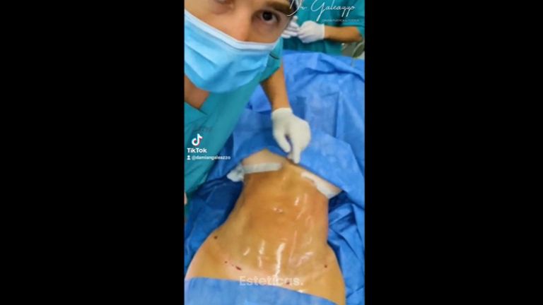 Liposucción - Dr Damián Galeazzo y Equipo