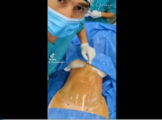 Liposucción - Dr Damián Galeazzo y Equipo