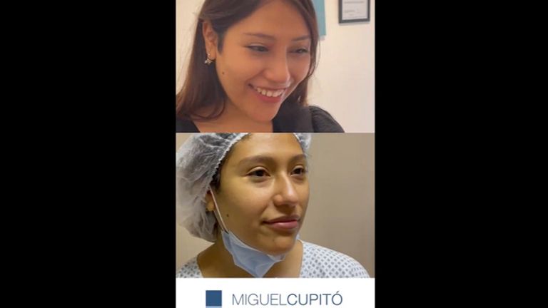 Rinoplastia - Dr. Miguel Ángel Cupito