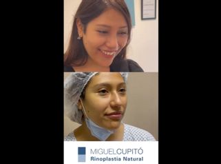 Rinoplastia - Dr. Miguel Ángel Cupito