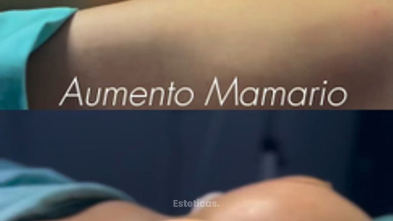 Aumento Mamario - Dr. Cristian Gansslen