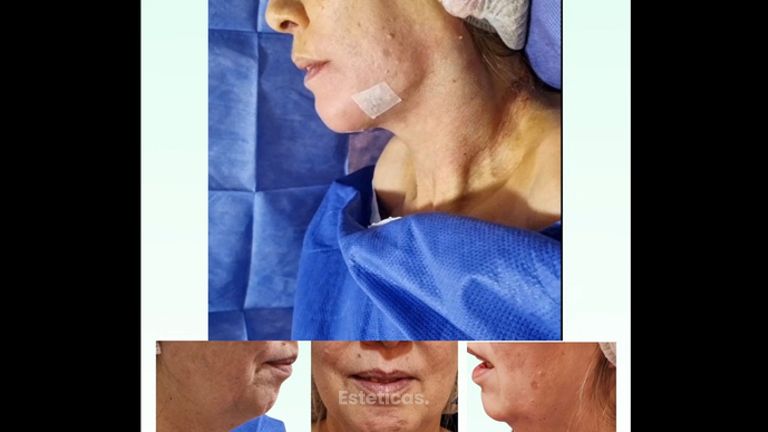 Liposucción de papada - Dra. Laura Marin