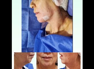 Liposucción de papada - Dra. Laura Marin