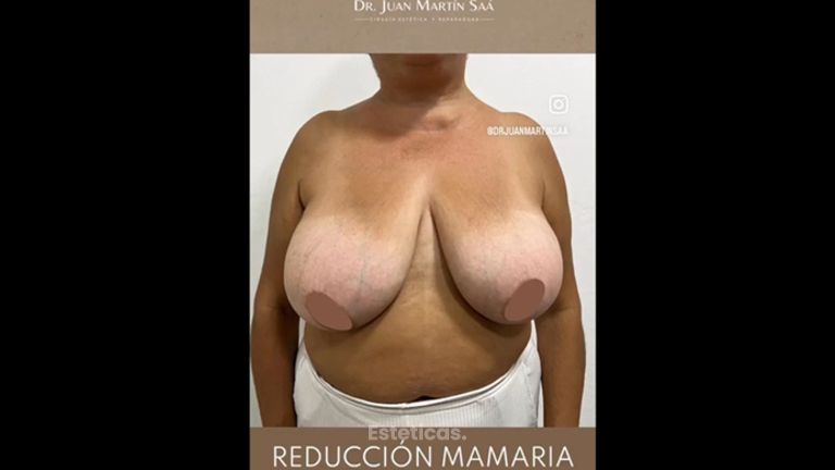 Reducción mamas - Dr. Juan Martín Saá