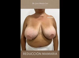 Reducción mamas - Dr. Juan Martín Saá