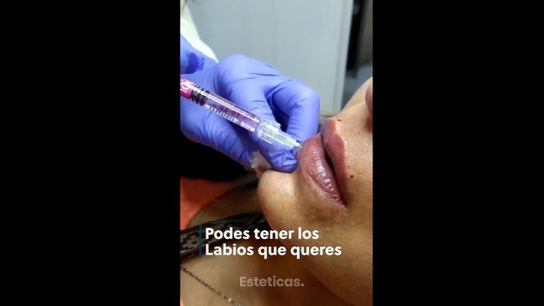 Relleno de labios - Dra. Torrijos Noelia