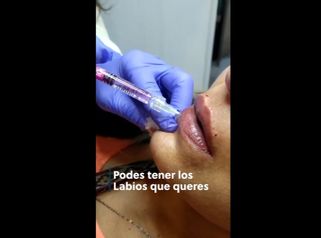 Relleno de labios - Dra. Torrijos Noelia