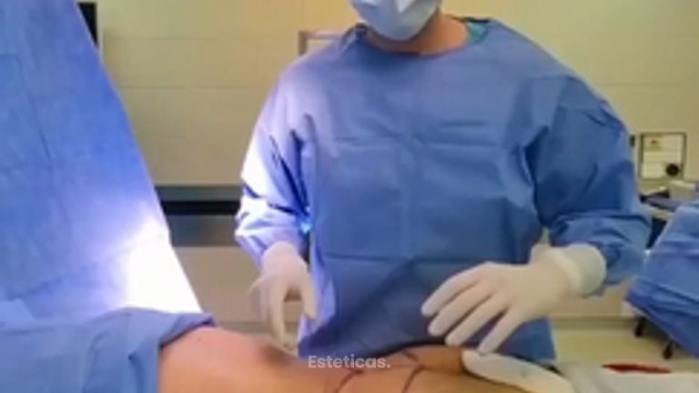 Abdominoplastia - Dr. Damián Galeazzo y Equipo