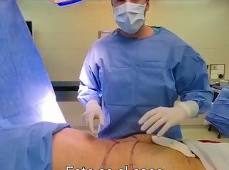 Abdominoplastia - Dr. Damián Galeazzo y Equipo