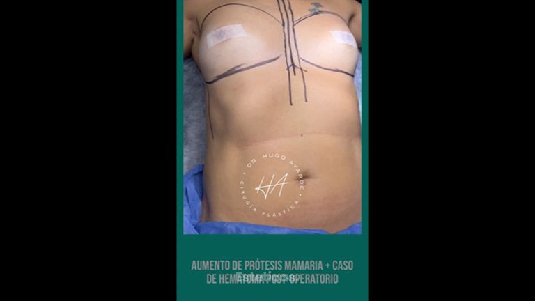 Aumento mamas - Dr. Hugo Ayarde