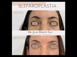 Blefaroplastia - Dr. Juan Martín Saá