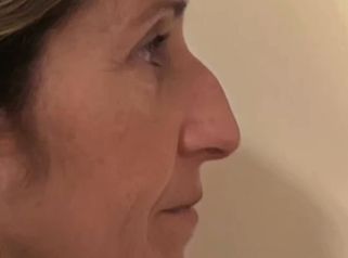 Rinoplastia - Dra. María de la Paz Vélez