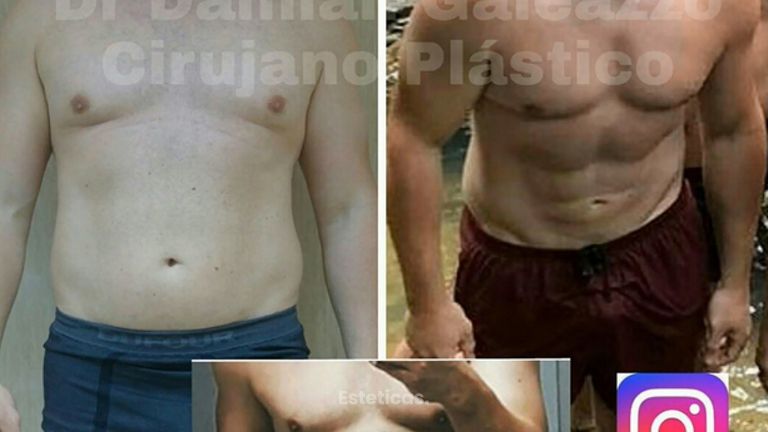 Marcación abdominal.