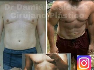 Marcación abdominal.