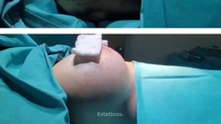 Aumento mamas - Dr. Walter Gabriel Huck - Centro Médico Alvear