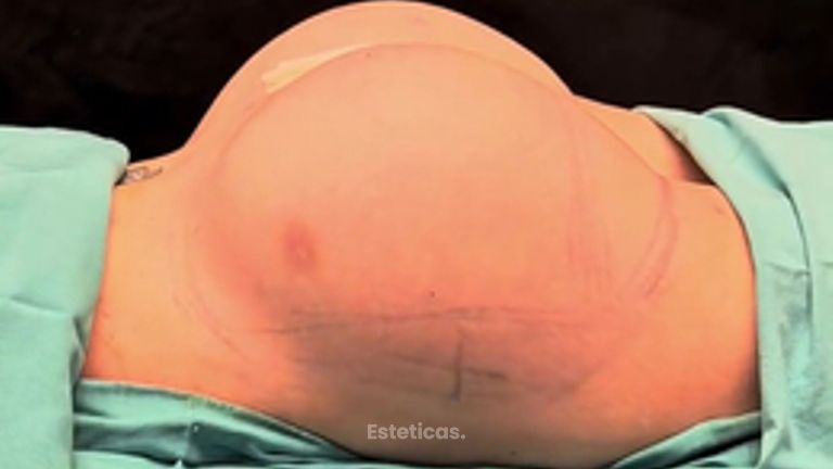 Aumento de Glúteos - Dr. Damián Wengrowicz