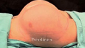 Aumento de Glúteos - Dr. Damián Wengrowicz