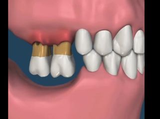 Implante dental - Dental Advance