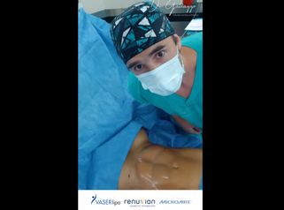Abdominoplastia - Dr. Damián Galeazzo y Equipo