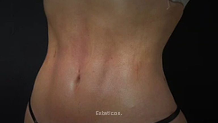 Lipoescultura - Dr. Honorio Labaronnie