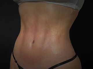 Lipoescultura - Dr. Honorio Labaronnie